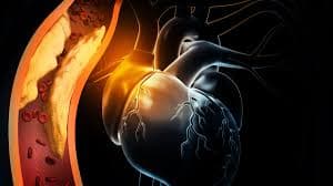 Dislipidemia